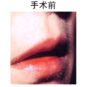 玻尿酸豐唇多少錢