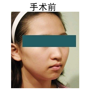 成功矯正歪鼻子