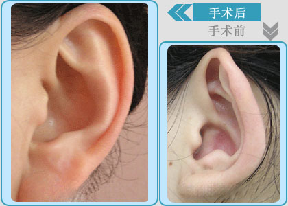 寶寶招風(fēng)耳怎么辦