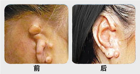 菜花耳矯正術(shù)前需要注意什么