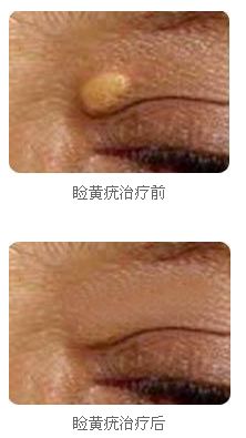青島治療瞼黃疣效果如何