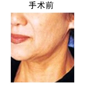 深藍(lán)射頻除皺多少錢