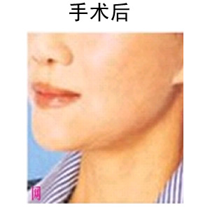 深藍(lán)射頻除皺要多少錢