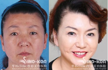 botox oĜpgg(sh)