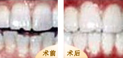 美白牙齒小竅門