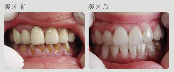 冷光牙齒美白副作用