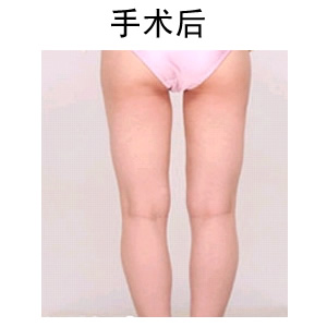 陰道再造術(shù)