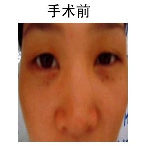 雙眼皮手術(shù)