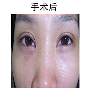 雙眼皮手術(shù)