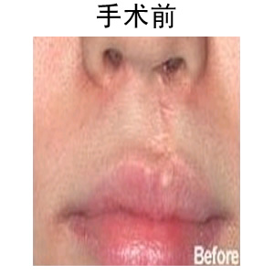 唇部整形修復(fù)術(shù)