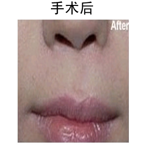 唇部整形修復(fù)術(shù)
