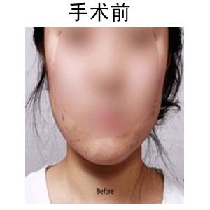 取頰脂墊