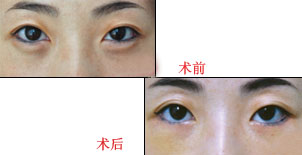 醫(yī)生解析電波拉皮祛除眼袋效果