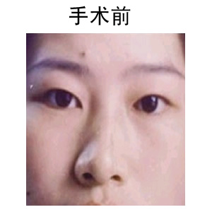 切開雙眼皮