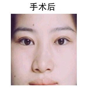 做切開雙眼皮