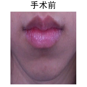 厚唇變薄