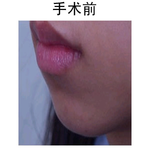 厚唇變薄多少錢