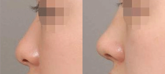 注射隆鼻用的材料都有哪些