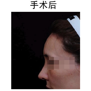 注射隆鼻整形需要多少錢
