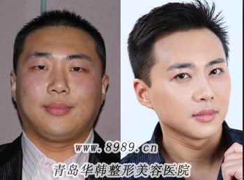 射頻瘦臉對比