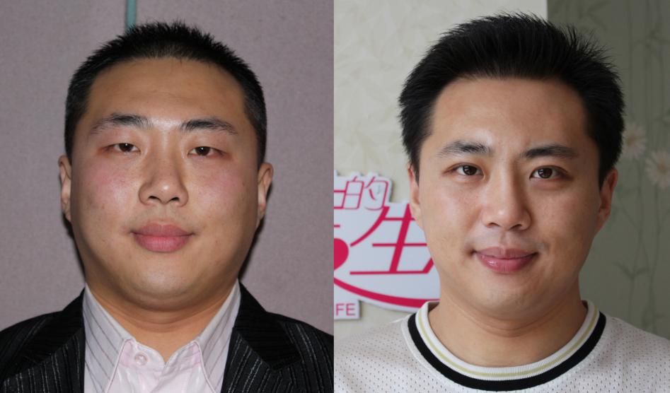 下巴吸脂對比照
