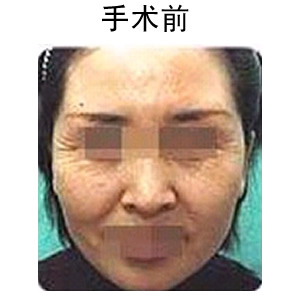 玻尿酸注射除皺