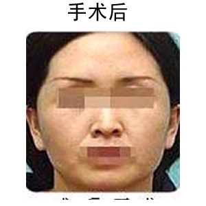 玻尿酸注射除皺