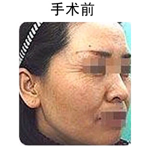 玻尿酸除皺多少錢