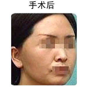 玻尿酸除皺多少錢