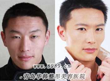陽光上瞼下垂矯正對比照片