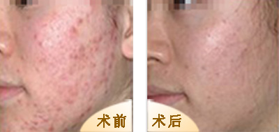 彩光祛痘多少錢