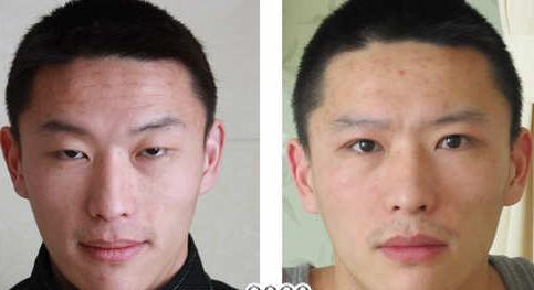上瞼下垂矯正對比照
