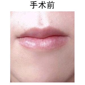 薄唇變厚整形