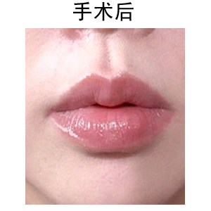薄唇變厚整形