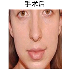 薄唇變厚多少錢