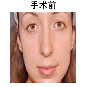 薄唇變厚多少錢