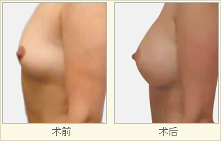 胸部修復多少錢