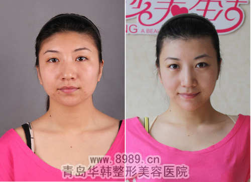 楊文華冰點(diǎn)脫發(fā)際線毛發(fā)前后對(duì)比照片