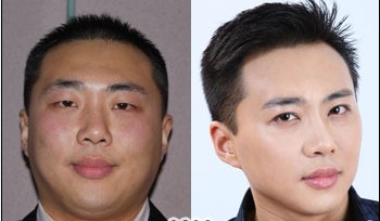 謝磊抽脂減肥前后對比照片