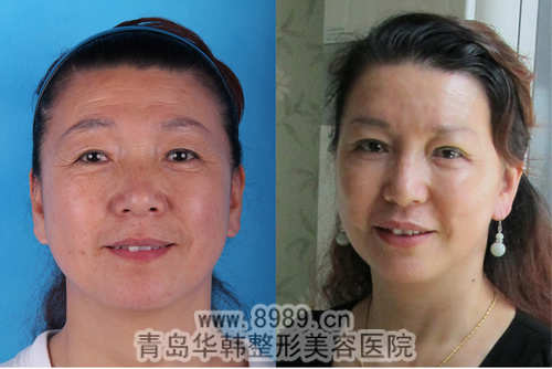 李東風(fēng)眼部吸脂前后對(duì)比照片
