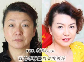 李東風(fēng)豐唇前后對(duì)比照片