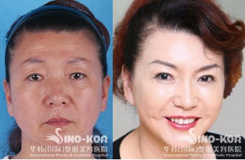 眼袋很重怎么辦