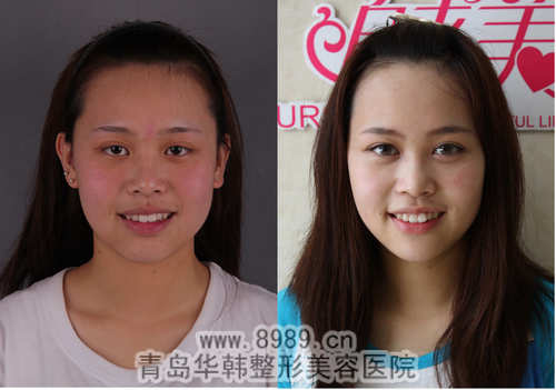 劉云唇部脫毛前后對比照片