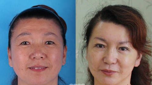 李東風(fēng)自身脂肪豐唇前后對(duì)比照片