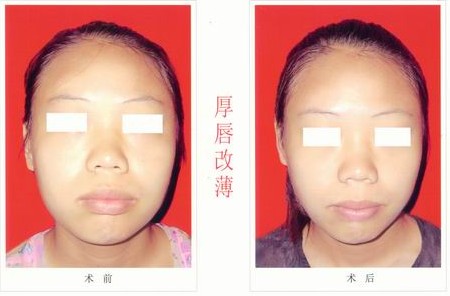 怎樣把厚嘴唇變薄