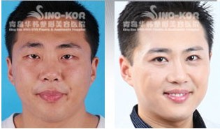 謝磊激光脫毛前后對比照片