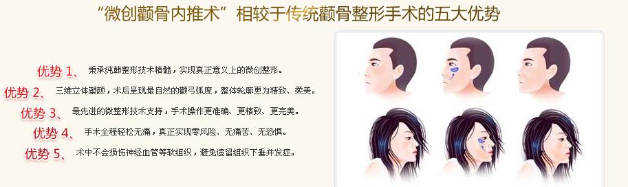 微創(chuàng)顴骨整形