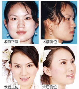 趙婷婷厚唇改薄前后對(duì)比照片