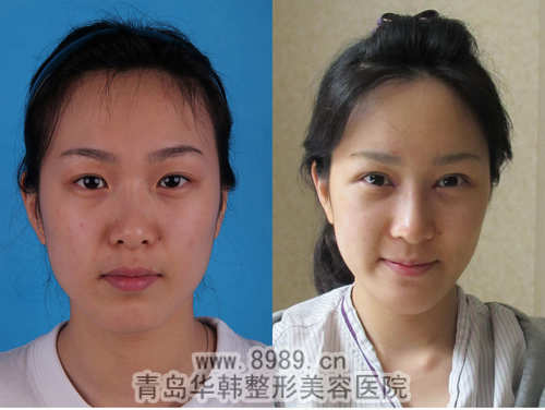 蘇曉蕾光子祛斑前后對比照片