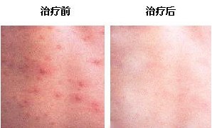 青島哪里用激光治療尋常疣